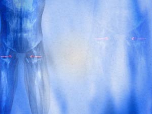 Superior Gemellus Muscle Title Content PowerPoint Template