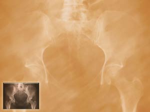 Hip Bones X-ray Title Content PowerPoint Template